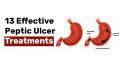 13 Effective Peptic Ulcer Treatments