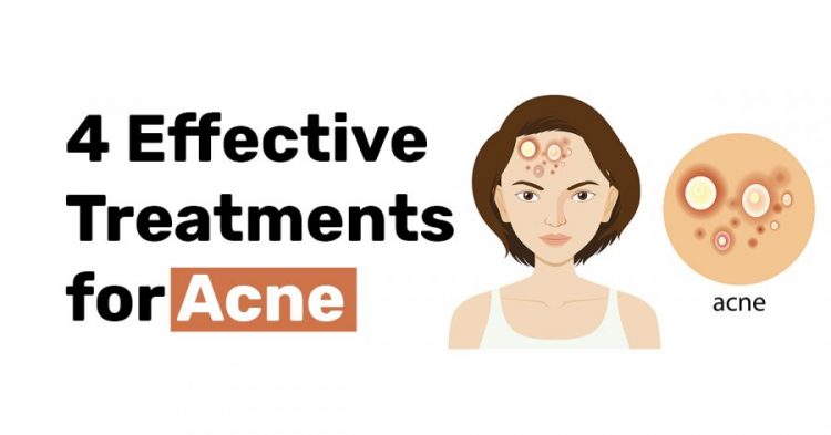 4 Effective Treatments for Acne