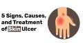 5 Signs Causes and Treatment of Skin Ulcer