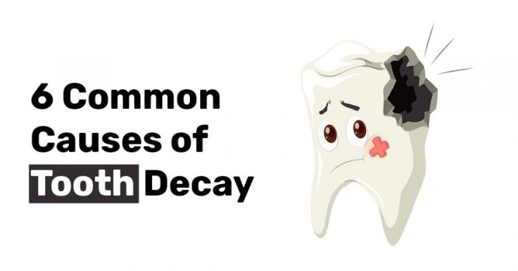6 Common Causes of Tooth Decay