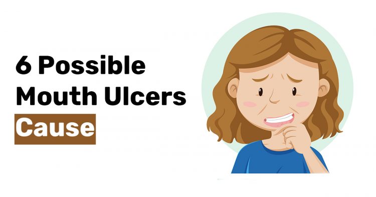 6 Possible Mouth Ulcers Cause