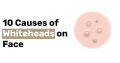 10 Causes of Whiteheads on Face