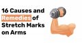 16 Causes and Remedies of Stretch Marks on Arms