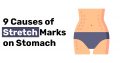 9 Causes of Stretch Marks on Stomach